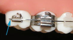 Emergencies  Metal Braces in Wayne County, Indiana