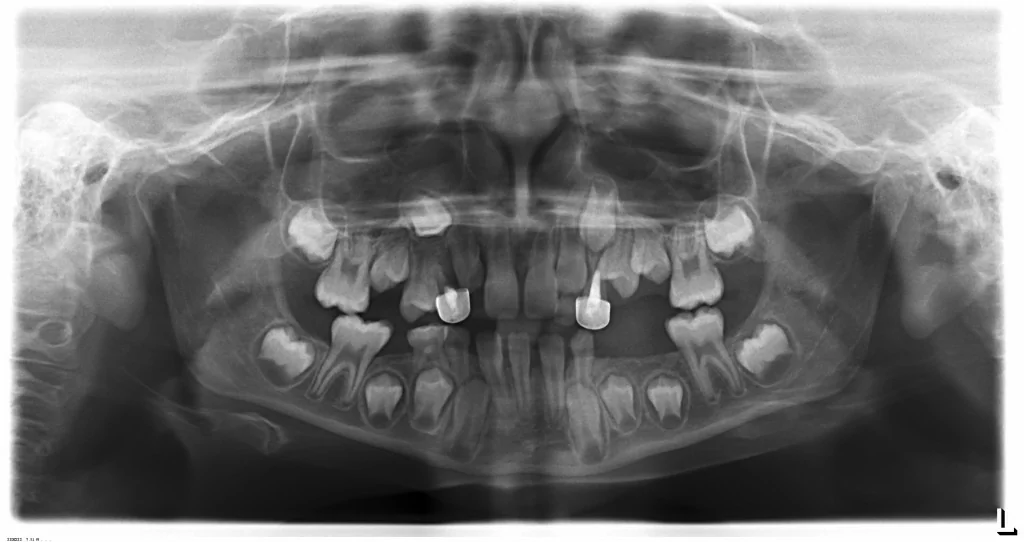 tube head in panorama x rays