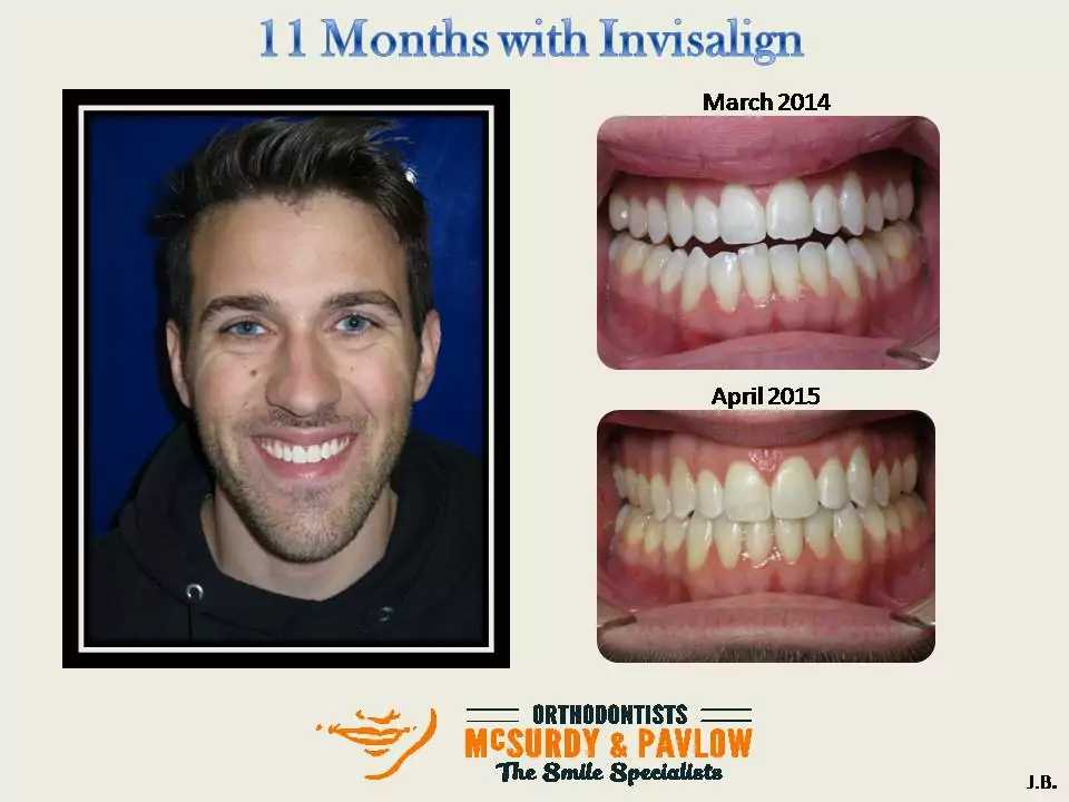 Accelerated Invisalign