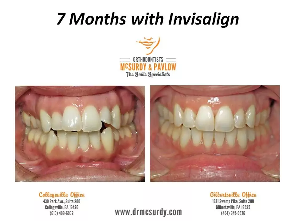 Invisalign before and after photos 