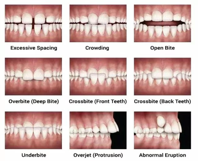 Overbite Correction Cost