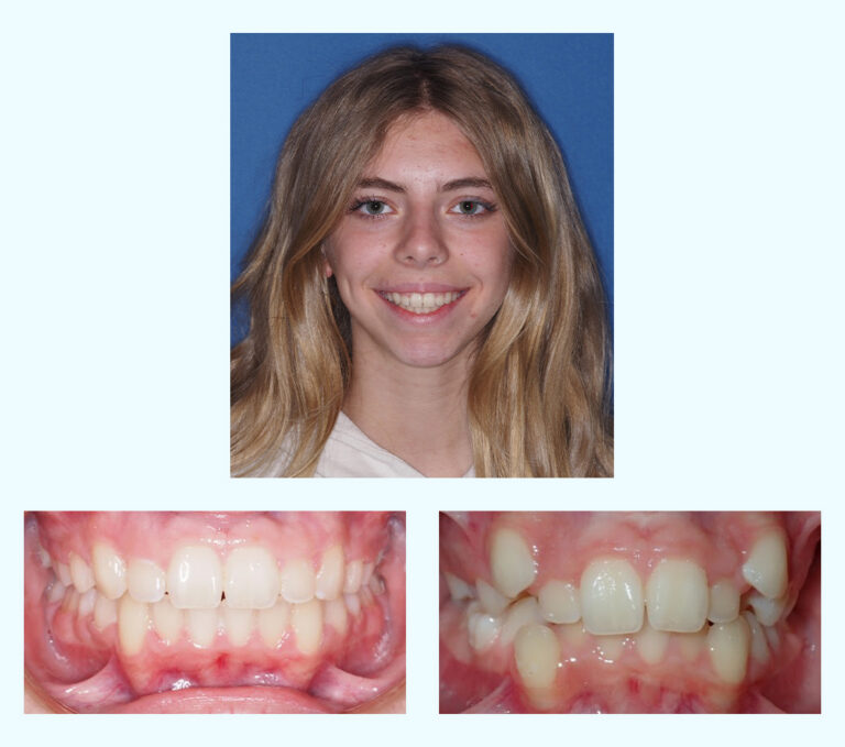 Catherine Before After