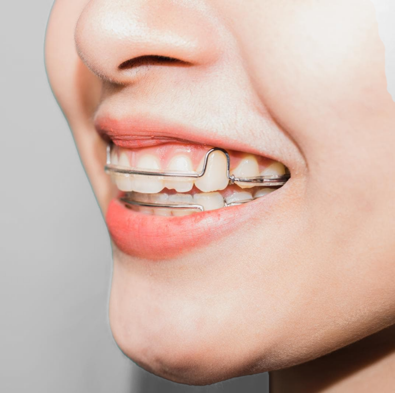 Closeup Of Smiling Person With Retainers