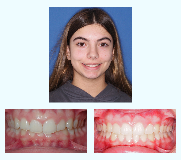 Fabiana Before After