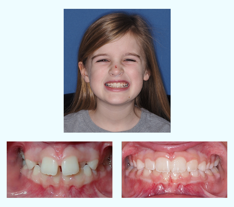 Harper Before After