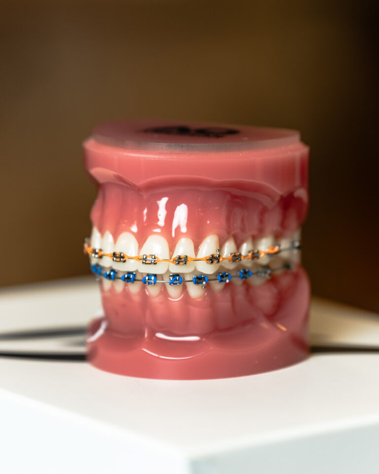 Model Of Braces