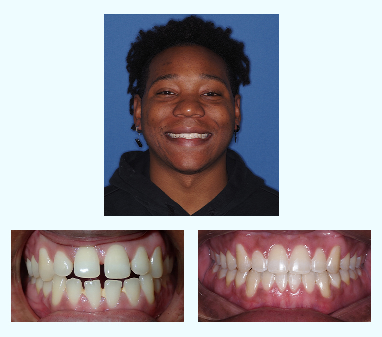 Yameer Before After